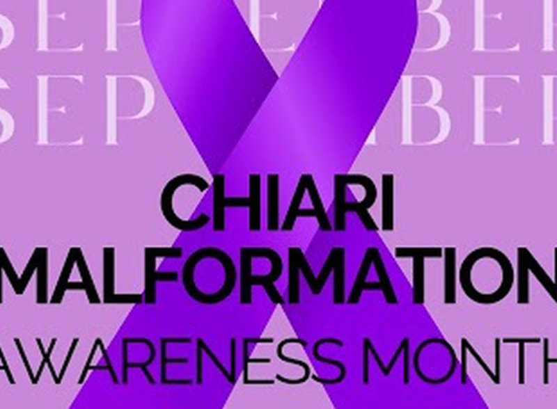 Michelle & Family are beating Chiairi & Hydrocephalus
