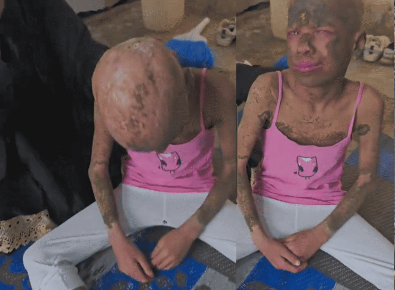 A Little Girl Fighting Every Day for Her Life – She Needs the World’s Help Now